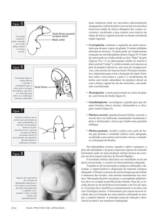 raras instâncias pode ser necessário adicionalmente
 Figura   5                                         alongamento ventral do pênis com incisão (ou incisões)
                                                    transversa ampla da túnica albugínea dos corpos ca-
                                                    vernosos, recobrindo a área cruenta com enxerto em
    Curvatura                                       elipse de túnica vaginal testicular ou derme retirada da
     ventral do                                     região inguinal.
pênis causada
    por tecido
                                                  • Uretroplastia: construir o segmento de uretra inexis-
 fibroso distal
      ao meato                                      tente que alcance o ápice da glande. Existem múltiplas
       uretral.                                     alternativas técnicas. O meato pode ser simplesmente
                                                    avançado até em hipospádias distais (f igura 9). O tubo
                                                    de uretra pode ser criado unindo-se dois “flaps” de pele
                                                    (figuras 10 e 11) ou adicionando retalho ou enxerto à
                                                    placa uretral (“onlay”), confeccionado com mucosa ou
 Figura   6                                         pele do prepúcio dorsal ou, em casos de cirurgias pré-
                                                    vias, com enxerto de mucosa bucal. Princípio elemen-
                                                    tar e importante para evitar a formação de trajeto fistu-
   O desenho ilustra o
                                                    loso entre a neo-uretra e a pele é o recobrimento da
        tecido fibroso                              uretra com tecido subcutâneo do prepúcio dorsal ou
          (“chordee”)                               com a túnica vaginal de um dos testículos, com pedí-
   visualizado após a                               culo vascularizado.
 dissecção e retração
do prepúcio, que deve
    ser removido para                             • Meatoplastia: o meato posicionado no centro da glan-
obter-se a retificação                              de, com forma de fenda (figura 8).
  peniana adequada.
                                                  • Glanduloplastia: reconfigurar a glande para que ad-
                                                    quira formato cônico normal, eliminando-se a cliva-
                                                    gem ventral (figura 8).
 Figura   7
                                                  • Plástica escrotal: quando presente bifidez escrotal, o
   Incisões verticais com os                        escroto deve ser rebaixado, aumentando visualmente o
  pontos que aproximam as
      suas extremidades. As                         pênis e desfazendo a forma que lembra uma genitália
     incisões são paralelas,                        ambígua.
             laterais ao feixe
  vasculonervoso e opostas                        • Plástica peniana: recobrir o pênis com a pele de for-
          ao ponto de maior
        curvatura ventral. O                        ma que permita o resultado estético mais adequado,
encurtamento da superfície                          recobrindo a neo-uretra com tecidos viáveis, evitando-
           dorsal promove a                         se a formação de fístulas.
        retificação peniana.
                                                   Nas hipospádias severas, quando o pênis é pequeno, a
                                             pele não-abundante e de pouca espessura (apesar do estímulo
 Figura   8                                  hormonal), pode ser mais prudente utilizar técnica de corre-
                                             ção em dois tempos (técnica de Tiersch-Duplay).
                                                   O resultado estético ideal deve ser semelhante ao de um
                                             pênis circuncisado, e a uretra ser funcionalmente adequada.
                                                   Tratando-se de reconstruções cirúrgicas elaboradas e de-
                                             licadas, é imprescindível a disposição de material cirúrgico
                                             adequado. Utilizam-se pinças de microcirurgia que permitam
                                             o manuseio dos tecidos, com mínimo traumatismo aos mes-
    Aspecto pós-operatório                   mos. Maceração da pele com pinças e conseqüente epidermó-
             de correção de
   hipospádia demonstra o
                                             lise deve ser evitada na profilaxia das fístulas. Para tal, os te-
   novo meato com formato                    cidos devem ser de preferência tracionados com fios de repa-
    de fenda (meatoplastia)                  ro. O auxiliar deve umidificar constantemente os tecidos com
           e a glande com o                  soro fisiológico morno. A hemostasia, por causar necrose te-
     formato cônico normal
                 obtido pela
                                             cidual, deve ser limitada aos vasos maiores utilizando-se sem-
           glanduloplastia.                  pre o cautério bipolar. A principal causa de infecção e deis-
                                             cência tecidual é seu manuseio inadequado.

354               GUIA PRÁTICO DE UROLOGIA
 