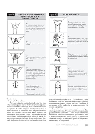 Figura   9     TÉCNICA DE REPOSICIONAMENTO                             Figura   10         TÉCNICA DE BARCAT
                     DO MEATO URETRAL E
                      GLANDULOPLASTIA*
                                                                                                    A-
                                                                                                    O retângulo, tendo como ponto
                               A-
                                                                                                    mediano o meato uretral, uma vez
                               As linhas pontilhadas demonstram a
                                                                                                    incisado, formará dois “flaps” que,
                               circuncisão coronal, incisão em
                                                                                                    unidos, formarão a neo-uretra.
                               torno do meato uretral e incisão de
                               clivagem da glande, distalmente ao
                               meato.



                                                                                                    B-
                                                                                                    Confeccionados os dois “flaps” com
                                                                                                    o meato uretral no centro, e clivada
                               B-                                                                   amplamente a glande para abrigar a
                               A glande encontra-se amplamente                                      neo-uretra no seu interior.
                               clivada.




                                                                                                    C-
                               C-                                                                   O “flap” distal tem sua extremidade
                               Pontos separados, circulares, com fio                                suturada à glande, formando metade
                               PDS 6-0, tracionam o meato à sua                                     do meato uretral.
                               nova posição.




                               D-
                               Pontos no tecido esponjoso                                           D-
                               aproximam os bordos da glande. O                                     Duas linhas laterais de sutura
                               epitélio que recobria a clivagem da                                  contínua unem os dois “flaps”,
                               face ventral da glande foi removido,                                 criando o tudo de neo-uretra, que é
                               permitindo a aproximação de tecido                                   coberto pela glande aproximada na
                               glandar com glandar                                                  linha média.
                               (glanduloplastia).




                               E-                                                                   E-
                               Linhas de sutura após a                                              Linhas de sutura após a construção
                               meatoplastia, glanduloplastia e                                      da neo-uretra, meatoplastia,
                               plástica peniana.                                                    glanduloplastia e plástica peniana.


                                * Idealizada pelo autor do capítulo


Cuidados no                                                            o paciente da umidade da urina, e a externa absorve a urina
pós-operatório imediato                                                drenada pela sonda. Em reconstruções complexas, principal-
     A drenagem da urina pode ser facilitada para evitar o seu         mente quando se opta por enxertos livres para a confecção da
extravasamento para o interior dos tecidos cruentos e para di-         neo-uretra, a melhor opção pode ser uma drenagem por cis-
minuir o desconforto das micções. Pode-se utilizar um peque-           tostomia suprapúbica.
no segmento de sonda, um pouco maior que a extensão da                      O curativo deve ser o menos compressivo possível para
uretra construída, no seu interior, presa por pontos ao meato          evitar isquemia tecidual. O edema natural favorece uma ade-
uretral para facilitar o fluxo da urina. Outra alternativa, em         quada coaptação dos tecidos. O autor utiliza somente uma
pacientes que ainda utilizam fraldas, é uma sonda de silicone          pomada com fibrinolítico e antibiótico aplicada várias vezes
multiperfurada na porção localizada no interior da bexiga, fixa        ao dia para manter tecidos limpos. Justifica-se curativo com
por pontos no meato uretral e que fica drenando em um siste-           compressão suave por 48 horas apenas quando o cirurgião prevê
ma de dupla fralda descartável, isto é, a fralda interior protege      a possibilidade de sangramento.

                                                                                  GUIA PRÁTICO DE UROLOGIA                         355
 