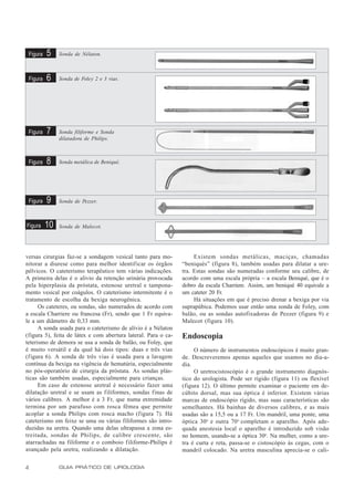 Figura   5    Sonda de Nélaton.



 Figura   6    Sonda de Foley 2 e 3 vias.




 Figura   7    Sonda filiforme e Sonda
               dilatadora de Philips.



 Figura   8    Sonda metálica de Beniqué.




 Figura   9    Sonda de Pezzer.



Figura    10   Sonda de Malecot.




versas cirurgias faz-se a sondagem vesical tanto para mo-            Existem sondas metálicas, maciças, chamadas
nitorar a diurese como para melhor identificar os órgãos        “beniqués” (figura 8), também usadas para dilatar a ure-
pélvicos. O cateterismo terapêutico tem várias indicações.      tra. Estas sondas são numeradas conforme seu calibre, de
A primeira delas é o alívio da retenção urinária provocada      acordo com uma escala própria – a escala Beniqué, que é o
pela hiperplasia da próstata, estenose uretral e tampona-       dobro da escala Charriere. Assim, um beniqué 40 equivale a
mento vesical por coágulos. O cateterismo intermitente é o      um cateter 20 Fr.
tratamento de escolha da bexiga neurogênica.                         Há situações em que é preciso drenar a bexiga por via
      Os cateteres, ou sondas, são numerados de acordo com      suprapúbica. Podemos usar então uma sonda de Foley, com
a escala Charriere ou francesa (Fr), sendo que 1 Fr equiva-     balão, ou as sondas autofixadoras de Pezzer (figura 9) e
le a um diâmetro de 0,33 mm.                                    Malecot (figura 10).
      A sonda usada para o cateterismo de alívio é a Nélaton
(figura 5), feita de látex e com abertura lateral. Para o ca-   Endoscopia
teterismo de demora se usa a sonda de balão, ou Foley, que
é muito versátil e da qual há dois tipos: duas e três vias           O número de instrumentos endoscópicos é muito gran-
(f igura 6). A sonda de três vias é usada para a lavagem        de. Descreveremos apenas aqueles que usamos no dia-a-
contínua da bexiga na vigência de hematúria, especialmente      dia.
no pós-operatório de cirurgia da próstata. As sondas plás-           O uretrocistoscópio é o grande instrumento diagnós-
ticas são também usadas, especialmente para crianças.           tico do urologista. Pode ser rígido (figura 11) ou flexível
      Em caso de estenose uretral é necessário fazer uma        (figura 12). O último permite examinar o paciente em de-
dilatação uretral e se usam as filiformes, sondas finas de      cúbito dorsal, mas sua óptica é inferior. Existem várias
vários calibres. A melhor é a 3 Fr, que numa extremidade        marcas de endoscópio rígido, mas suas características são
termina por um parafuso com rosca fêmea que permite             semelhantes. Há bainhas de diversos calibres, e as mais
acoplar a sonda Philips com rosca macho (figura 7). Há          usadas são a 15,5 ou a 17 Fr. Um mandril, uma ponte, uma
cateterismo em feixe se uma ou várias filiformes são intro-     óptica 30o e outra 70 o completam o aparelho. Após ade-
duzidas na uretra. Quando uma delas ultrapassa a zona es-       quada anestesia local o aparelho é introduzido sob visão
treitada, sondas de Philips, de calibre crescente, são          no homem, usando-se a óptica 30o. Na mulher, como a ure-
atarrachadas na filiforme e o comboio filiforme-Philips é       tra é curta e reta, passa-se o cistoscópio às cegas, com o
avançado pela uretra, realizando a dilatação.                   mandril colocado. Na uretra masculina aprecia-se o cali-


4              GUIA PRÁTICO DE UROLOGIA
 