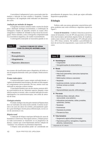 A urocultura é indispensável, pois a associação entre he-   procedimento de pequeno risco, desde que sejam utilizados
matúria e infecção do trato urinário é freqüente. Estudos        dispositivos apropriados.
sorológicos e da coagulação estão indicados em determina-
dos casos.                                                       Etiologia
Avaliação por métodos de imagem                                       Embora cada caso possa apresentar características pró-
     A urografia excretora continua sendo o exame de eleição     prias, podemos usar como referência o algoritmo exposto na
para a definição etiológica da hematúria; a combinação da        figura 1.
radiografia simples do aparelho urinário ao exame ultra-
sonográfico é também de utilidade na fase inicial da investi-         Causas de hematúria - A tabela 2 relaciona as possíveis
gação. Outros métodos, como a tomografia computadorizada         causas de hematúria. Cerca de 20% dos pacientes com hema-
ou a ressonância magnética, são usados ocasionalmente.           túria macroscópica apresentam alguma forma de neoplasia,
     A arteriografia renal pode ser necessária quando os ou-     sendo a mais comum o câncer da bexiga; 25% infecção uriná-
                                                                 ria e 20% litíase urinária. Há também a possibilidade de
                                                                 mais de um local de sangramento, o que ocorre em 10% dos
                                                                 casos.
 Tabela   1      CAUSAS COMUNS DE URINA
               COM COLORAÇÃO AVERMELHADA

     • Hematúria
     • Hemoglobinúria                                             Tabela   2            CAUSAS DE HEMATÚRIA
     • Mioglobinúria
                                                                    t Hematológicas
     • Pigmentos alimentares                                          • Coagulopatias
                                                                      • Hemoglobinopatias de células falciformes

                                                                    t Renais
tros exames são insuficientes para o diagnóstico de lesões re-        • Doenças glomerulares
nais de pequena dimensão como, por exemplo, fístula arterio-
                                                                      • Infecciosas (pielonefrites, tuberculose, leptospirose,
venosa.
                                                                        nefrites virais)
Exame endoscópico                                                     • Malformações (císticas ou vasculares)
      A uretrocistoscopia é quase sempre realizada durante a          • Neoplasias
vigência da hematúria macroscópica, devendo ser feita enquan-         • Isquêmicas (embolia, necrose cortical ou papilar,
to o sangramento estiver presente. Por isso, muitas vezes sua           trombose venosa ou arterial)
indicação se antecipa a outros exames.
                                                                      • Trauma
      A ejaculação hemática por um dos meatos ureterais defi-
ne a proveniência de um hemitrato superior. Quando o trato            • Hipersensibilidade (vasculite, nefrite alérgica)
inferior mostra-se normal, cabe a eventual indicação de urete-
                                                                    t Pós-renais
ropielografia e/ou ureterorrenoscopia, com coleta de amos-
tras de urina.                                                        • Mecânicas (litíase, obstrução, refluxo
                                                                        vesicoureteral, corpo estranho)
Citologia urinária                                                    • Inflamatórias (periureterites, cistites, prostatites,
     O estudo citológico da urina pelo método de Papanicolaou           epididimites, uretrites)
deve ser realizado com urina recém-emitida. Costuma ser po-           • Neoplasias
sitivo em casos de câncer do urotélio, principalmente quan-           • Endometriose
do o grau histológico mostra pouca diferenciação, ou nos ca-
sos de carcinoma in situ.                                             • Hiperplasia da próstata
                                                                      • Pós-exercício físico
Biópsia renal
     A indicação de biópsia renal para definição de causa de        t Falsa hematúria
hematúria é controversa. Para alguns autores, a biópsia pouco         • Sangramento vaginal artificial (simulação)
ou nada acrescentará ao tratamento ou ao prognóstico da               • Pigmentúria (porfirina, hemoglobina, mioglobina,
doença, a menos que exista hipertensão arterial, redução do             alimentos, medicamentos)
“clearance” de creatinina ou proteinúria importante.                Adaptada de J.G. Abuelo.
     A biópsia renal percutânea poder ser considerada um


48            GUIA PRÁTICO DE UROLOGIA
 