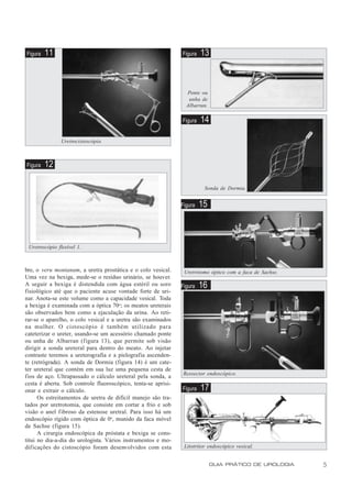 Figura   11                                                    Figura   13



                                                                 Ponte ou
                                                                  unha de
                                                                 Albarran.

                                                               Figura   14

               Uretrocistoscópio.



Figura   12

                                                                         Sonda de Dormia.


                                                               Figura   15



 Uretroscópio flexível 1.



bre, o veru montanum, a uretra prostática e o colo vesical.     Uretrótomo óptico com a faca de Sachse.
Uma vez na bexiga, mede-se o resíduo urinário, se houver.
A seguir a bexiga é distendida com água estéril ou soro        Figura   16
fisiológico até que o paciente acuse vontade forte de uri-
nar. Anota-se este volume como a capacidade vesical. Toda
a bexiga é examinada com a óptica 70o; os meatos ureterais
são observados bem como a ejaculação da urina. Ao reti-
rar-se o aparelho, o colo vesical e a uretra são examinados
na mulher. O cistoscópio é também utilizado para
cateterizar o ureter, usando-se um acessório chamado ponte
ou unha de Albarran (figura 13), que permite sob visão
dirigir a sonda ureteral para dentro do meato. Ao injetar
contraste teremos a ureterografia e a pielografia ascenden-
te (retrógrada). A sonda de Dormia (figura 14) é um cate-
ter ureteral que contém em sua luz uma pequena cesta de
                                                                Ressector endoscópico.
fios de aço. Ultrapassado o cálculo ureteral pela sonda, a
cesta é aberta. Sob controle fluoroscópico, tenta-se aprisi-
onar e extrair o cálculo.                                      Figura   17
      Os estreitamentos de uretra de difícil manejo são tra-
tados por uretrotomia, que consiste em cortar a frio e sob
visão o anel fibroso da estenose uretral. Para isso há um
endoscópio rígido com óptica de 0o, munido da faca móvel
de Sachse (figura 15).
      A cirurgia endoscópica da próstata e bexiga se cons-
titui no dia-a-dia do urologista. Vários instrumentos e mo-
dificações do cistoscópio foram desenvolvidos com esta          Litotritor endoscópico vesical.


                                                                             GUIA PRÁTICO DE UROLOGIA     5
 