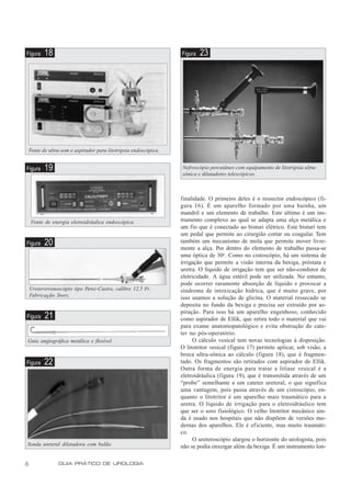 Figura    18                                                   Figura   23




Fonte de ultra-som e aspirador para litotripsia endoscópica.


Figura    19                                                   Nefroscópio percutâneo com equipamento de litotripsia ultra-
                                                               sônica e dilatadores telescópicos.



                                                               finalidade. O primeiro deles é o ressector endoscópico (fi-
                                                               gura 16). É um aparelho formado por uma bainha, um
                                                               mandril e um elemento de trabalho. Este último é um ins-
    Fonte de energia eletroidráulica endoscópica.              trumento complexo ao qual se adapta uma alça metálica e
                                                               um fio que é conectado ao bisturi elétrico. Este bisturi tem
                                                               um pedal que permite ao cirurgião cortar ou coagular. Tem
Figura    20                                                   também um mecanismo de mola que permite mover livre-
                                                               mente a alça. Por dentro do elemento de trabalho passa-se
                                                               uma óptica de 30o. Como no cistoscópio, há um sistema de
                                                               irrigação que permite a visão interna da bexiga, próstata e
                                                               uretra. O líquido de irrigação tem que ser não-condutor de
                                                               eletricidade. A água estéril pode ser utilizada. No entanto,
                                                               pode ocorrer raramente absorção de líquido e provocar a
    Ureterorrenoscópio tipo Perez-Castro, calibre 12,5 Fr.     síndrome de intoxicação hídrica, que é muito grave, por
    Fabricação Storz.                                          isso usamos a solução de glicina. O material ressecado se
                                                               deposita no fundo da bexiga e precisa ser extraído por as-
                                                               piração. Para isso há um aparelho engenhoso, conhecido
Figura    21                                                   como aspirador de Ellik, que retira todo o material que vai
                                                               para exame anatomopatológico e evita obstrução do cate-
                                                               ter no pós-operatório.
Guia angiográfica metálica e flexível.                              O cálculo vesical tem novas tecnologias à disposição.
                                                               O litotritor vesical (figura 17) permite aplicar, sob visão, a
                                                               broca ultra-sônica ao cálculo (figura 18), que é fragmen-
Figura    22                                                   tado. Os fragmentos são retirados com aspirador de Ellik.
                                                               Outra forma de energia para tratar a litíase vesical é a
                                                               eletroidráulica (figura 19), que é transmitida através de um
                                                               “probe” semelhante a um cateter ureteral, o que significa
                                                               uma vantagem, pois passa através de um cistoscópio, en-
                                                               quanto o litotritor é um aparelho mais traumático para a
                                                               uretra. O líquido de irrigação para o eletroidráulico tem
                                                               que ser o soro fisiológico. O velho litotritor mecânico ain-
                                                               da é usado nos hospitais que não dispõem de versões mo-
                                                               dernas dos aparelhos. Ele é eficiente, mas muito traumáti-
                                                               co.
                                                                    O ureteroscópio alargou o horizonte do urologista, pois
Sonda ureteral dilatadora com balão.                           não se podia enxergar além da bexiga. É um instrumento lon-


6                GUIA PRÁTICO DE UROLOGIA
 