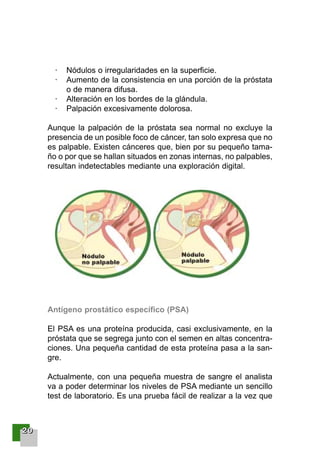 22220000
· Nódulos o irregularidades en la superficie.
· Aumento de la consistencia en una porción de la próstata
o de manera difusa.
· Alteración en los bordes de la glándula.
· Palpación excesivamente dolorosa.
Aunque la palpación de la próstata sea normal no excluye la
presencia de un posible foco de cáncer, tan solo expresa que no
es palpable. Existen cánceres que, bien por su pequeño tama-
ño o por que se hallan situados en zonas internas, no palpables,
resultan indetectables mediante una exploración digital.
Antígeno prostático específico (PSA)
El PSA es una proteína producida, casi exclusivamente, en la
próstata que se segrega junto con el semen en altas concentra-
ciones. Una pequeña cantidad de esta proteína pasa a la san-
gre.
Actualmente, con una pequeña muestra de sangre el analista
va a poder determinar los niveles de PSA mediante un sencillo
test de laboratorio. Es una prueba fácil de realizar a la vez que
001-120 Guia Prostata 18/2/04 16:23 Página 20
 