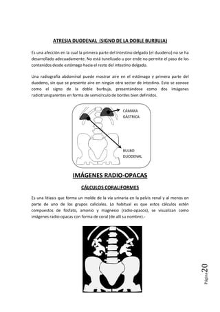 Página20
ATRESIA DUODENAL (SIGNO DE LA DOBLE BURBUJA)
Es una afección en la cual la primera parte del intestino delgado (el duodeno) no se ha
desarrollado adecuadamente. No está tunelizado u por ende no permite el paso de los
contenidos desde estómago hacia el resto del intestino delgado.
Una radiografía abdominal puede mostrar aire en el estómago y primera parte del
duodeno, sin que se presente aire en ningún otro sector de intestino. Esto se conoce
como el signo de la doble burbuja, presentándose como dos imágenes
radiotransparentes en forma de semicírculo de bordes bien definidos.
IMÁGENES RADIO-OPACAS
CÁLCULOS CORALIFORMES
Es una litiasis que forma un molde de la vía urinaria en la pelvis renal y al menos en
parte de uno de los grupos caliciales. Lo habitual es que estos cálculos estén
compuestos de fosfato, amonio y magnesio (radio-opacos), se visualizan como
imágenes radio-opacas con forma de coral (de allí su nombre).-
CÁMARA
GÁSTRICA
BULBO
DUODENAL
 