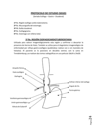 Página24
PROTOCOLO DE ESTUDIO (SEGD)
(Seriada Esófago – Gastro – Duodenal)
1º Rx. Región esófago cardio tuberositaria.
2º Rx. Mucosografía del estomago.
3º RX. Bulbo duodenal.
4º Rx. Esofagograma.
5º Rx. Estomago con relleno total.
1º Rx. REGIÓN ESOFAGOCARDIOTUBEROSITARIA
Utilizada para valorar imagenológicamente esta región y confirmar o descartar la
presencia de Hernia de Hiato. También se utiliza para el diagnóstico imagenológico de
enfermedad por reflujo gastro-esofágico (pudiéndose realizar con o sin maniobra de
Valsalva). Al paciente se lo posiciona en decúbito ventral, con la cama en
Trendelemburg y se realizan dos tomas radiográficas en una película 18x24 o 24x30.
Esfínter inferior del esófago
Angulo de His
Fornix gástrico
Ampolla frénica
Hiato esofágico
Diafragma
Vestíbulo gastroesofágico
Unión gastroesofágica
Válvula de Gubaroff
 