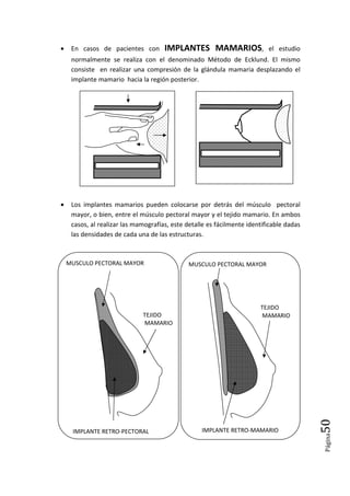 Página50
• En casos de pacientes con IMPLANTES MAMARIOS, el estudio
normalmente se realiza con el denominado Método de Ecklund. El mismo
consiste en realizar una compresión de la glándula mamaria desplazando el
implante mamario hacia la región posterior.
• Los implantes mamarios pueden colocarse por detrás del músculo pectoral
mayor, o bien, entre el músculo pectoral mayor y el tejido mamario. En ambos
casos, al realizar las mamografías, este detalle es fácilmente identificable dadas
las densidades de cada una de las estructuras.
MUSCULO PECTORAL MAYOR
IMPLANTE RETRO-MAMARIO
TEJIDO
MAMARIO
IMPLANTE RETRO-PECTORAL
TEJIDO
MAMARIO
MUSCULO PECTORAL MAYOR
 