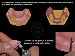 Guia rodetes de altura prótesis parcial.pdf