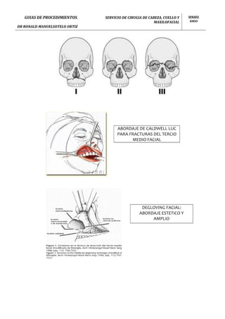 Guias de Procedimientos Cirugia de Cabeza, Cuello y Maxilofacial - Hospital Nacional Hipolito Unanue