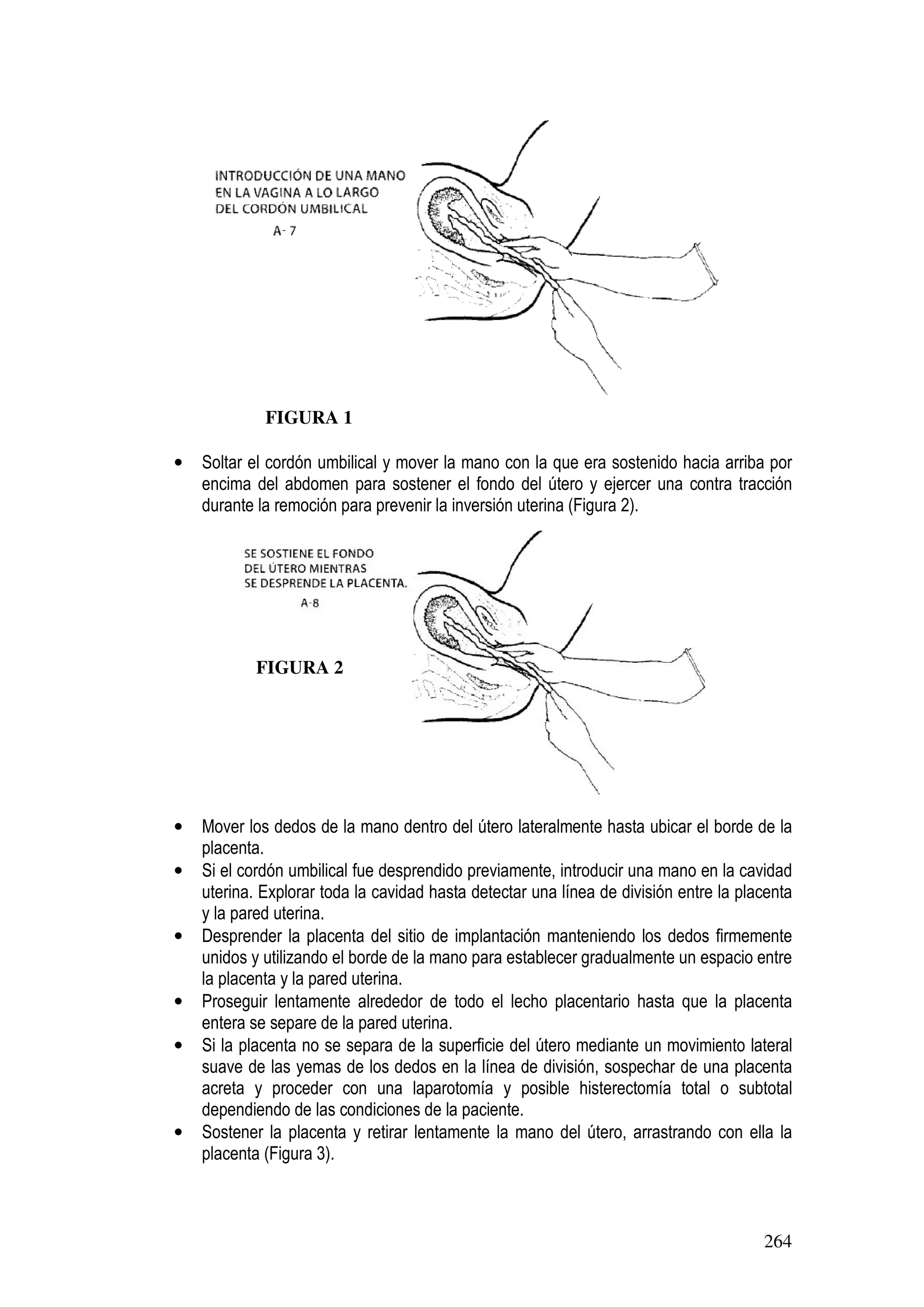 264
• Soltar el cordón umbilical y mover la mano con la que era sostenido hacia arriba por
encima del abdomen para sostener el fondo del útero y ejercer una contra tracción
durante la remoción para prevenir la inversión uterina (Figura 2).
• Mover los dedos de la mano dentro del útero lateralmente hasta ubicar el borde de la
placenta.
• Si el cordón umbilical fue desprendido previamente, introducir una mano en la cavidad
uterina. Explorar toda la cavidad hasta detectar una línea de división entre la placenta
y la pared uterina.
• Desprender la placenta del sitio de implantación manteniendo los dedos firmemente
unidos y utilizando el borde de la mano para establecer gradualmente un espacio entre
la placenta y la pared uterina.
• Proseguir lentamente alrededor de todo el lecho placentario hasta que la placenta
entera se separe de la pared uterina.
• Si la placenta no se separa de la superficie del útero mediante un movimiento lateral
suave de las yemas de los dedos en la línea de división, sospechar de una placenta
acreta y proceder con una laparotomía y posible histerectomía total o subtotal
dependiendo de las condiciones de la paciente.
• Sostener la placenta y retirar lentamente la mano del útero, arrastrando con ella la
placenta (Figura 3).
FIGURA 1
FIGURA 2
 