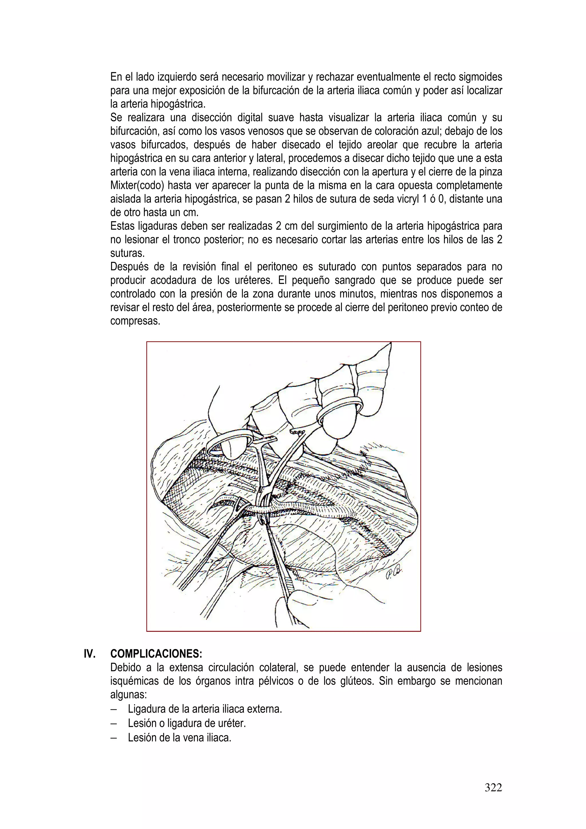 322
En el lado izquierdo será necesario movilizar y rechazar eventualmente el recto sigmoides
para una mejor exposición de la bifurcación de la arteria iliaca común y poder así localizar
la arteria hipogástrica.
Se realizara una disección digital suave hasta visualizar la arteria iliaca común y su
bifurcación, así como los vasos venosos que se observan de coloración azul; debajo de los
vasos bifurcados, después de haber disecado el tejido areolar que recubre la arteria
hipogástrica en su cara anterior y lateral, procedemos a disecar dicho tejido que une a esta
arteria con la vena iliaca interna, realizando disección con la apertura y el cierre de la pinza
Mixter(codo) hasta ver aparecer la punta de la misma en la cara opuesta completamente
aislada la arteria hipogástrica, se pasan 2 hilos de sutura de seda vicryl 1 ó 0, distante una
de otro hasta un cm.
Estas ligaduras deben ser realizadas 2 cm del surgimiento de la arteria hipogástrica para
no lesionar el tronco posterior; no es necesario cortar las arterias entre los hilos de las 2
suturas.
Después de la revisión final el peritoneo es suturado con puntos separados para no
producir acodadura de los uréteres. El pequeño sangrado que se produce puede ser
controlado con la presión de la zona durante unos minutos, mientras nos disponemos a
revisar el resto del área, posteriormente se procede al cierre del peritoneo previo conteo de
compresas.
IV. COMPLICACIONES:
Debido a la extensa circulación colateral, se puede entender la ausencia de lesiones
isquémicas de los órganos intra pélvicos o de los glúteos. Sin embargo se mencionan
algunas:
− Ligadura de la arteria iliaca externa.
− Lesión o ligadura de uréter.
− Lesión de la vena iliaca.
 