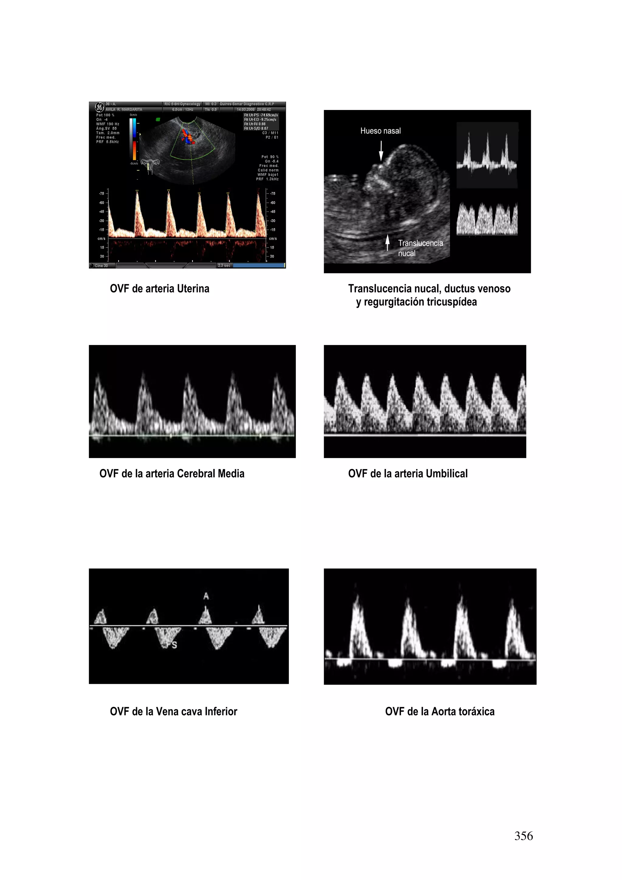 356
OVF de arteria Uterina Translucencia nucal, ductus venoso
y regurgitación tricuspídea
OVF de la arteria Cerebral Media OVF de la arteria Umbilical
OVF de la Vena cava Inferior OVF de la Aorta toráxica
 