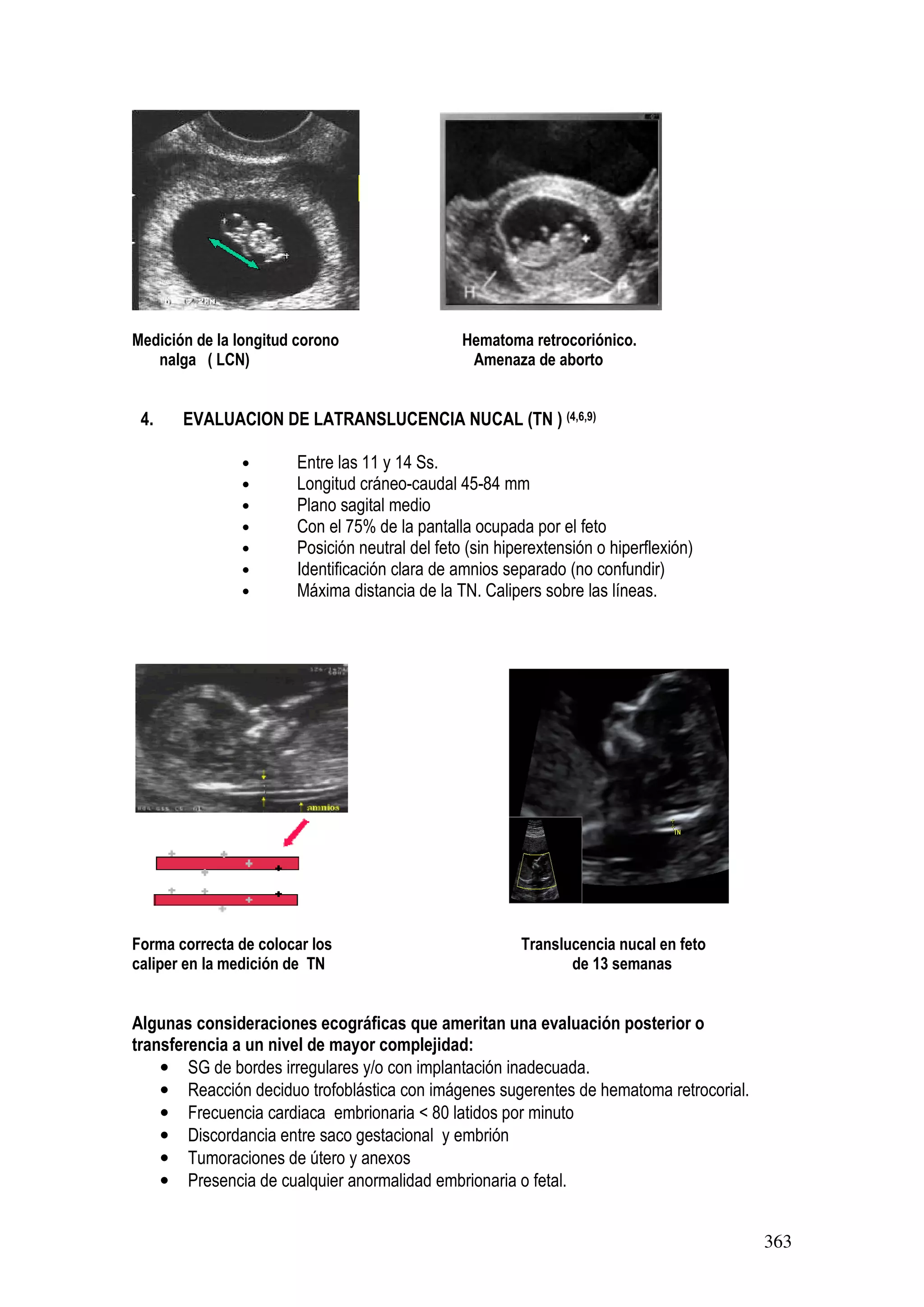 363
Medición de la longitud corono Hematoma retrocoriónico.
nalga ( LCN) Amenaza de aborto
4. EVALUACION DE LATRANSLUCENCIA NUCAL (TN ) (4,6,9)
• Entre las 11 y 14 Ss.
• Longitud cráneo-caudal 45-84 mm
• Plano sagital medio
• Con el 75% de la pantalla ocupada por el feto
• Posición neutral del feto (sin hiperextensión o hiperflexión)
• Identificación clara de amnios separado (no confundir)
• Máxima distancia de la TN. Calipers sobre las líneas.
Forma correcta de colocar los Translucencia nucal en feto
caliper en la medición de TN de 13 semanas
Algunas consideraciones ecográficas que ameritan una evaluación posterior o
transferencia a un nivel de mayor complejidad:
• SG de bordes irregulares y/o con implantación inadecuada.
• Reacción deciduo trofoblástica con imágenes sugerentes de hematoma retrocorial.
• Frecuencia cardiaca embrionaria < 80 latidos por minuto
• Discordancia entre saco gestacional y embrión
• Tumoraciones de útero y anexos
• Presencia de cualquier anormalidad embrionaria o fetal.
 