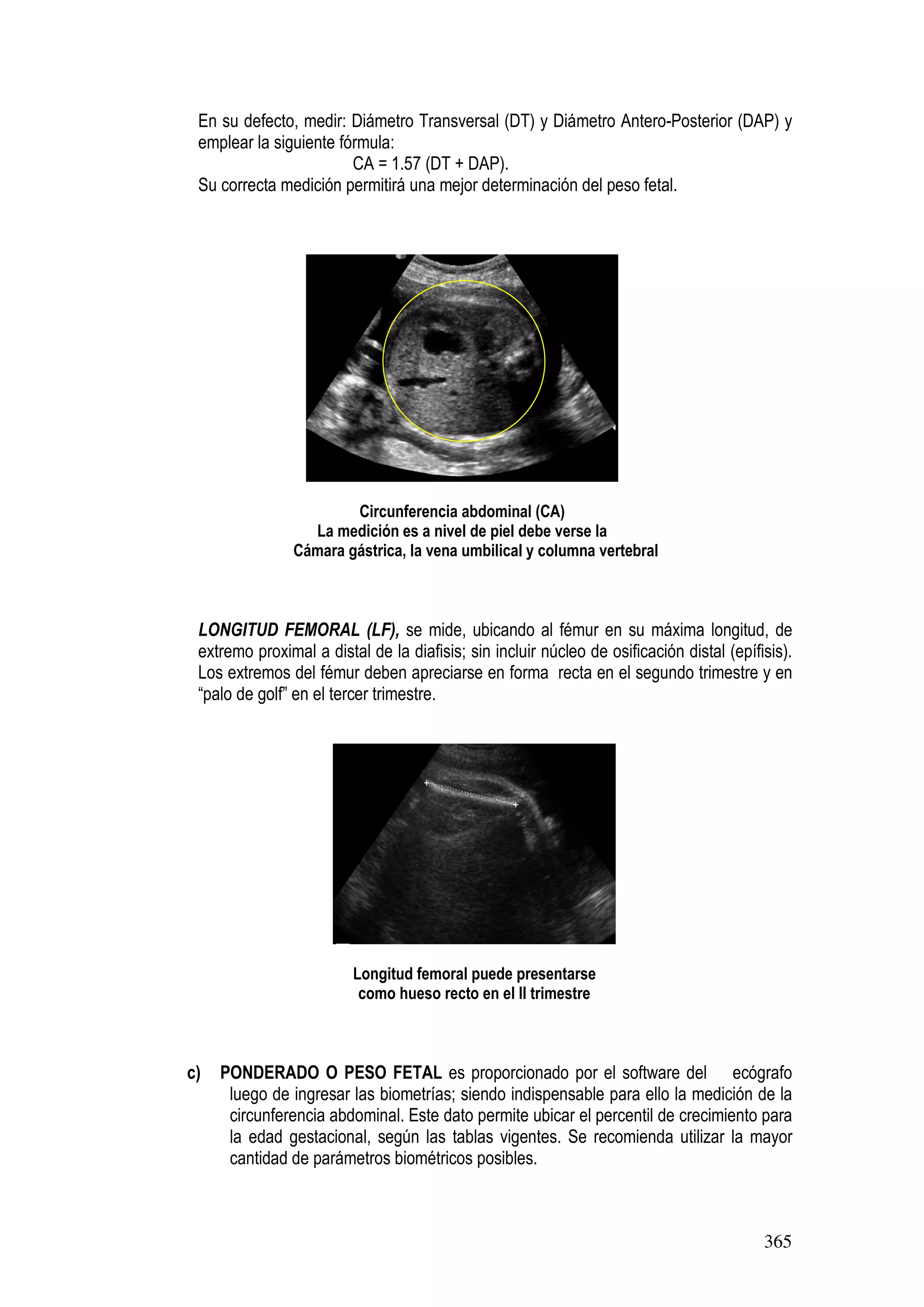 365
En su defecto, medir: Diámetro Transversal (DT) y Diámetro Antero-Posterior (DAP) y
emplear la siguiente fórmula:
CA = 1.57 (DT + DAP).
Su correcta medición permitirá una mejor determinación del peso fetal.
Circunferencia abdominal (CA)
La medición es a nivel de piel debe verse la
Cámara gástrica, la vena umbilical y columna vertebral
LONGITUD FEMORAL (LF), se mide, ubicando al fémur en su máxima longitud, de
extremo proximal a distal de la diafisis; sin incluir núcleo de osificación distal (epífisis).
Los extremos del fémur deben apreciarse en forma recta en el segundo trimestre y en
“palo de golf” en el tercer trimestre.
Longitud femoral puede presentarse
como hueso recto en el II trimestre
c) PONDERADO O PESO FETAL es proporcionado por el software del ecógrafo
luego de ingresar las biometrías; siendo indispensable para ello la medición de la
circunferencia abdominal. Este dato permite ubicar el percentil de crecimiento para
la edad gestacional, según las tablas vigentes. Se recomienda utilizar la mayor
cantidad de parámetros biométricos posibles.
 