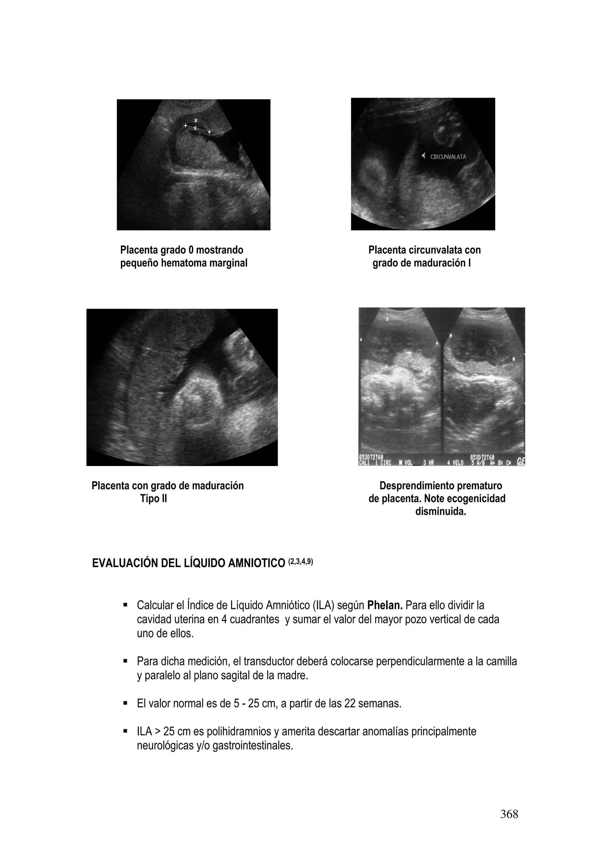 368
Placenta grado 0 mostrando Placenta circunvalata con
pequeño hematoma marginal grado de maduración I
Placenta con grado de maduración Desprendimiento prematuro
Tipo II de placenta. Note ecogenicidad
disminuida.
EVALUACIÓN DEL LÍQUIDO AMNIOTICO (2,3,4,9)
Calcular el Índice de Líquido Amniótico (ILA) según Phelan. Para ello dividir la
cavidad uterina en 4 cuadrantes y sumar el valor del mayor pozo vertical de cada
uno de ellos.
Para dicha medición, el transductor deberá colocarse perpendicularmente a la camilla
y paralelo al plano sagital de la madre.
El valor normal es de 5 - 25 cm, a partir de las 22 semanas.
ILA > 25 cm es polihidramnios y amerita descartar anomalías principalmente
neurológicas y/o gastrointestinales.
 