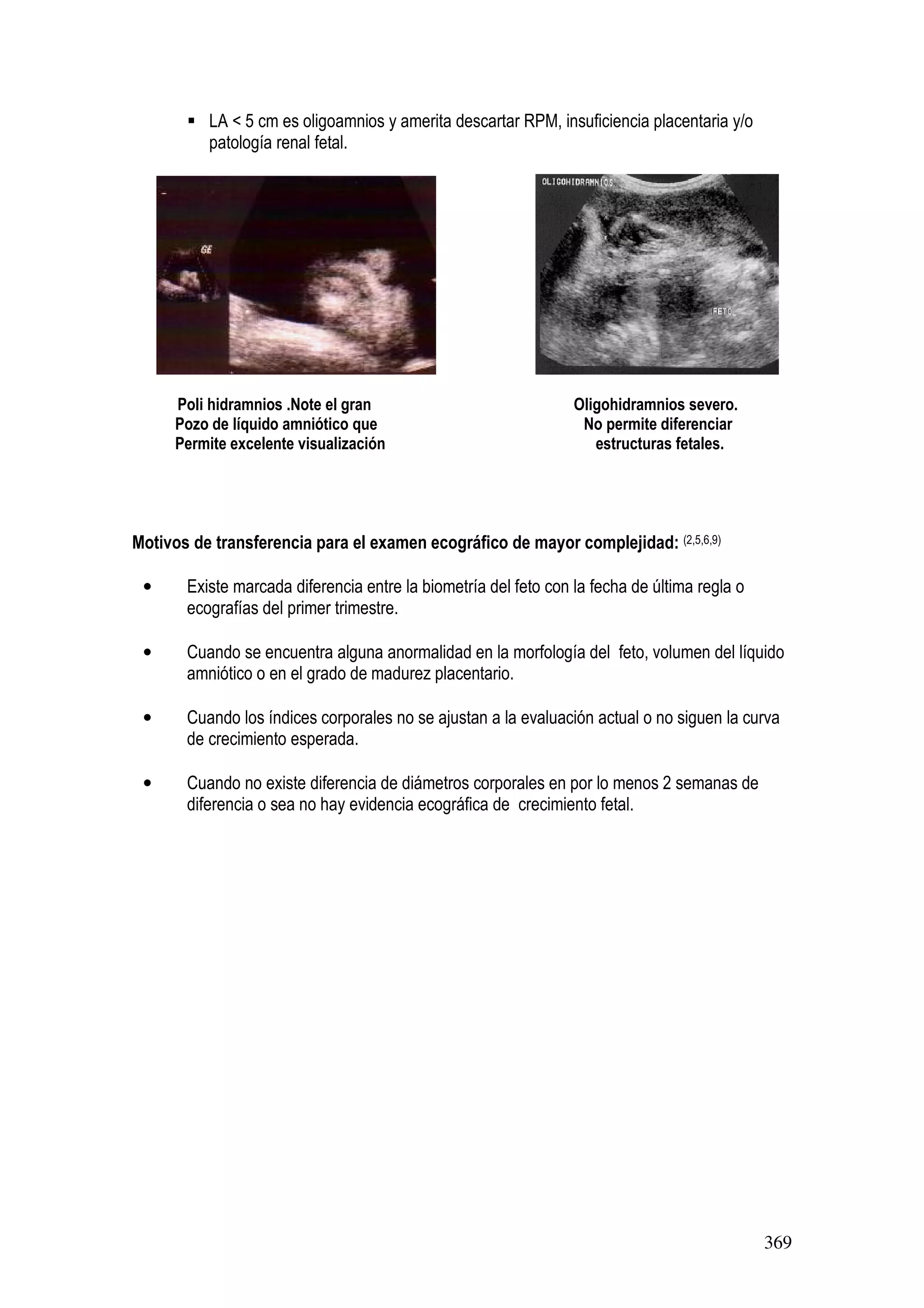 369
LA < 5 cm es oligoamnios y amerita descartar RPM, insuficiencia placentaria y/o
patología renal fetal.
Poli hidramnios .Note el gran Oligohidramnios severo.
Pozo de líquido amniótico que No permite diferenciar
Permite excelente visualización estructuras fetales.
Motivos de transferencia para el examen ecográfico de mayor complejidad: (2,5,6,9)
• Existe marcada diferencia entre la biometría del feto con la fecha de última regla o
ecografías del primer trimestre.
• Cuando se encuentra alguna anormalidad en la morfología del feto, volumen del líquido
amniótico o en el grado de madurez placentario.
• Cuando los índices corporales no se ajustan a la evaluación actual o no siguen la curva
de crecimiento esperada.
• Cuando no existe diferencia de diámetros corporales en por lo menos 2 semanas de
diferencia o sea no hay evidencia ecográfica de crecimiento fetal.
 