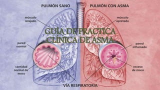 GUÍA DE PRACTICA
CLÍNICA DE ASMA
 