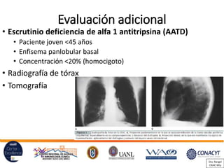Evaluación adicional
• Escrutinio deficiencia de alfa 1 antitripsina (AATD)
• Paciente joven <45 años
• Enfisema panlobular basal
• Concentración <20% (homocigoto)
• Radiografía de tórax
• Tomografía
Dra. Rangel
CRAIC Mty
 