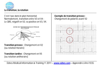 La transition, la rotation

C’est l’axe dans le plan horizontal.            Exemple de transition précoce :
Normalement, transition entre V3 et V4 :        Changement de polarité avant V2
Le QRS, négatif en V2, se positive en V3, V4.




Transition précoce : Changement en V2
(ou rotation horaire)

Transition tardive : Changement en V5
(ou rotation antihoraire)

  Ednes Medical Information & Training © 2011 – www.ednes.com – Apprendre à lire l’ECG
 