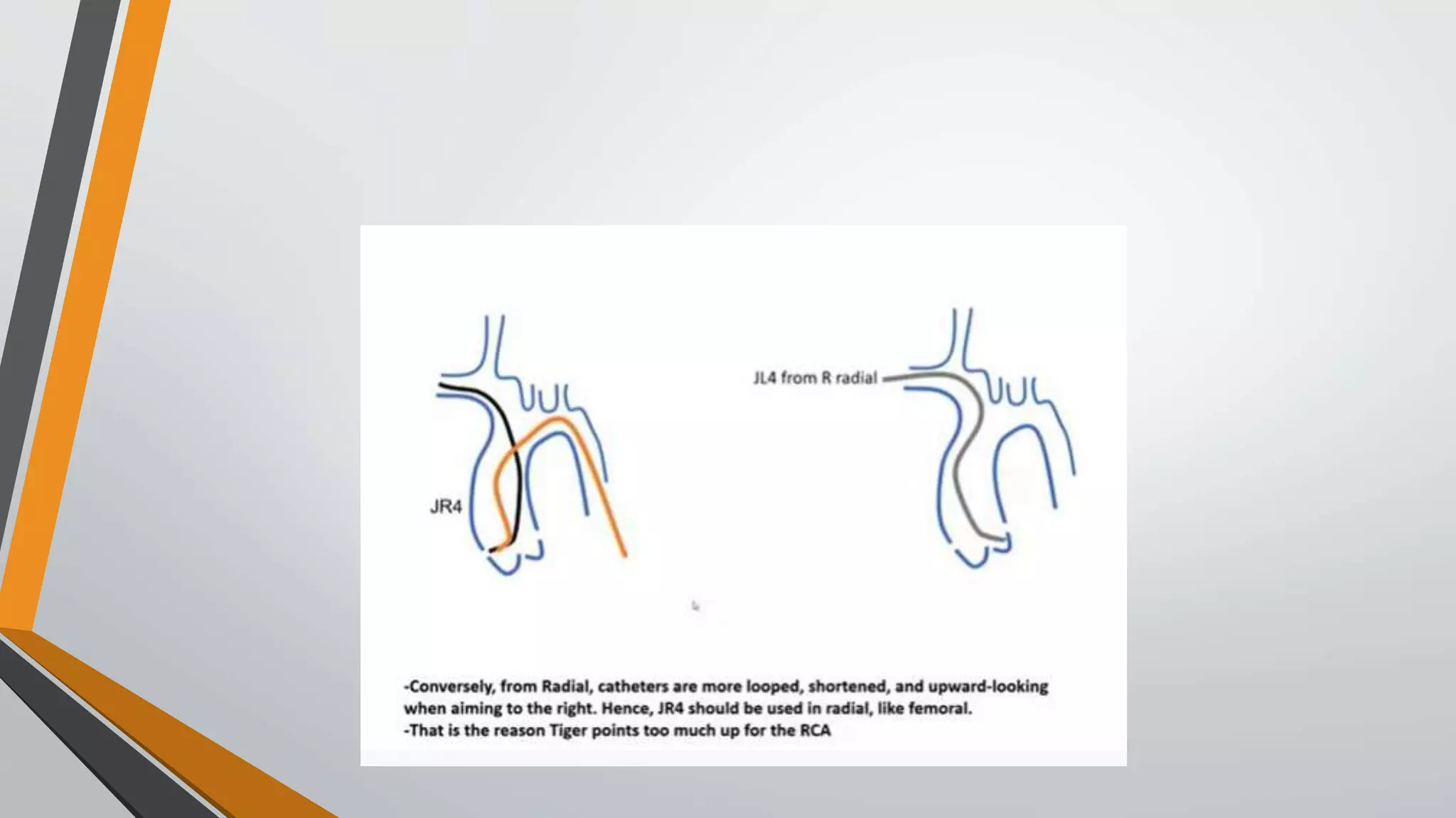 Guide catheters in coronary intervention | PPTX