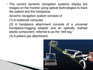 Comprehensive Guide to Static and Dynamic Guided Endodontics Techniques ...