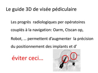 Le guide 3D de visée pédiculaire
Les progrès radiologiques per opératoires
couplés à la navigation: Oarm, Ctscan op,
Robot, … permettent d’augmenter la précision
du positionnement des implants et d’
éviter ceci…
 