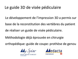 Le développement de l’impression 3D a permis sur
base de la reconstitution des vertèbres du patient
de réaliser un guide de visée pédiculaire.
Méthodologie déjà éprouvée en chirurgie
orthopédique: guide de coupe: prothèse de genou
Le guide 3D de visée pédiculaire
 