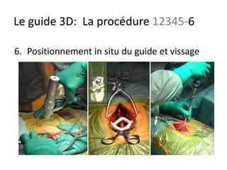 6. Positionnement in situ du guide et vissage
Le guide 3D: La procédure 12345-6
 