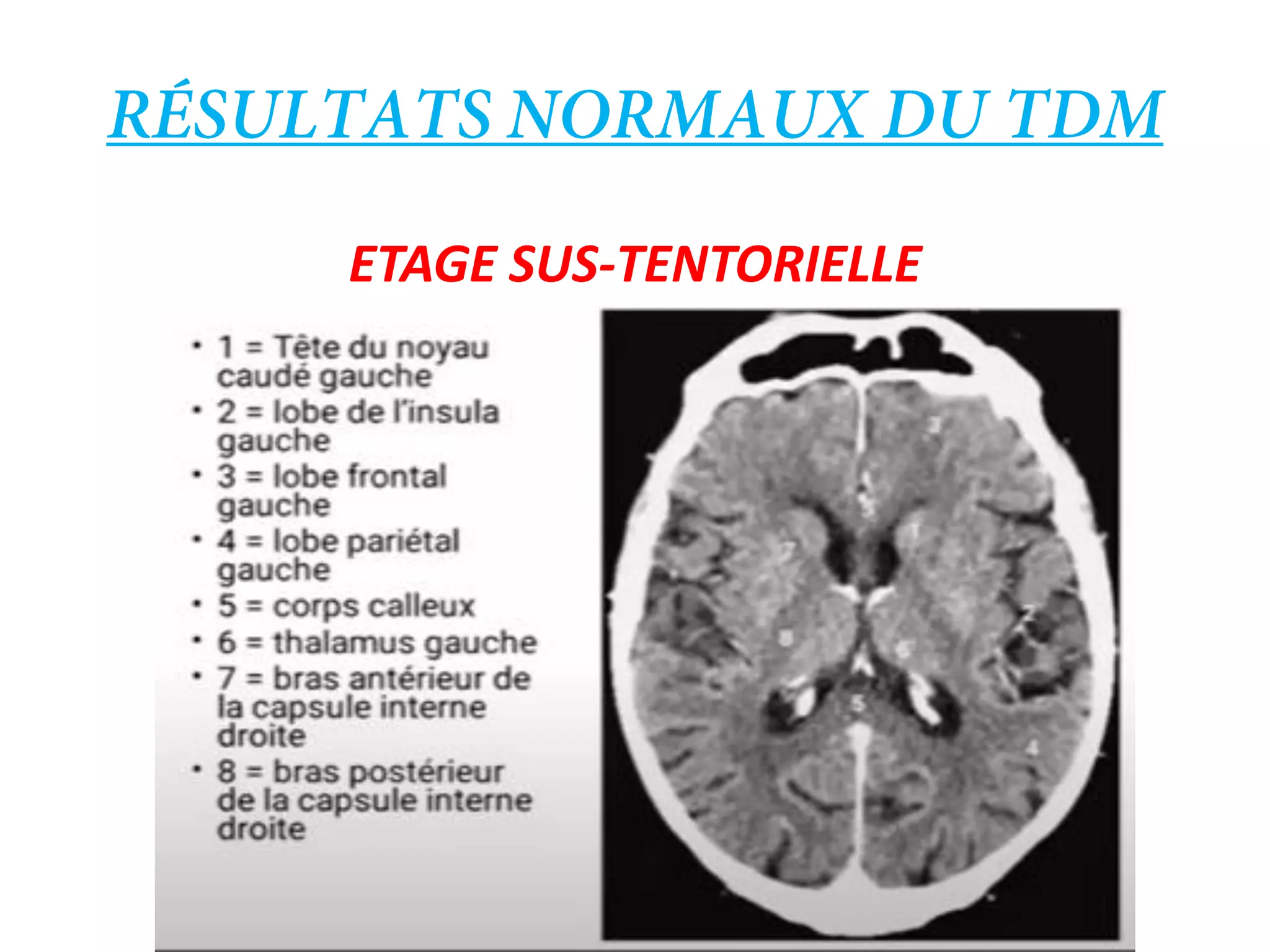 GUIDE D'INTERPRETATION D'UN TDM CEREBRALE EN URGENCE.pdf