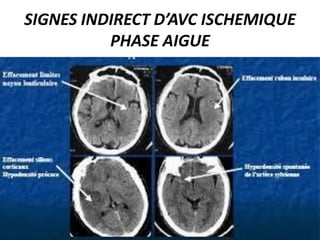 SIGNES INDIRECT D’AVC ISCHEMIQUE
PHASE AIGUE
 