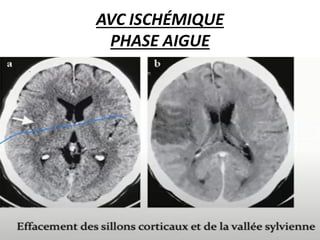 AVC ISCHÉMIQUE
PHASE AIGUE
 