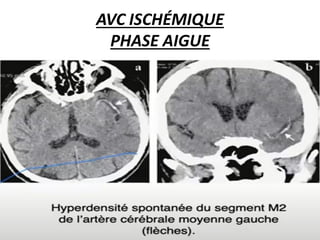 AVC ISCHÉMIQUE
PHASE AIGUE
 