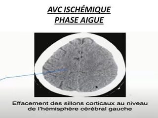 AVC ISCHÉMIQUE
PHASE AIGUE
 
