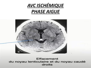 AVC ISCHÉMIQUE
PHASE AIGUE
 