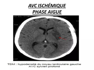AVC ISCHÉMIQUE
PHASE AIGUE
 