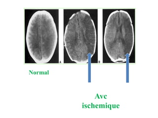 Normal
Avc
ischemique
 
