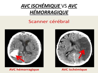 AVC ISCHÉMIQUE VS AVC
HÉMORRAGIQUE
 