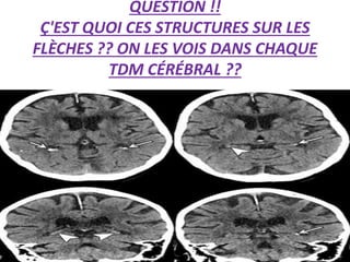 QUESTION !!
Ç'EST QUOI CES STRUCTURES SUR LES
FLÈCHES ?? ON LES VOIS DANS CHAQUE
TDM CÉRÉBRAL ??
 
