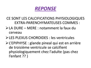 REPONSE
CE SONT LES CALCIFICATIONS PHYSIOLOGIQUES
EXTRA-PARENCHYMATEUSES COMMES :
LA DURE – MERE : notamment la faux du
cerveau
LES PLEXUS CHOROIDES : les ventricules
L’EPIPHYSE : glande pineal qui est en arrière
de troisième ventricule se calcifient
physiologiquement chez l'adulte (pas chez
l’enfant ?? )
 
