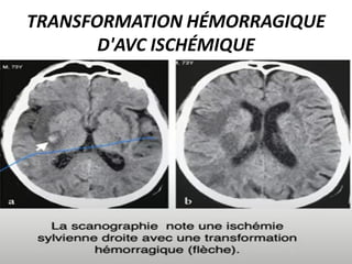 TRANSFORMATION HÉMORRAGIQUE
D'AVC ISCHÉMIQUE
 