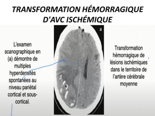 TRANSFORMATION HÉMORRAGIQUE
D'AVC ISCHÉMIQUE
 