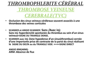 • Occlusion des sinus veineux cérébraux souvent associés à une
thrombose des veines corticales
• SCANNER et ANGIO SCANNER: Sans /Avec inj:
Sans inj: hyperdensité spontanée du thrombus au sein d’un sinus
veineux=SIGNE DU TRIANGLE DENSE.
• SCANNER avec inj: Zone hypodense d’un sinus(thrombus) cernée
d’une importante prise de contraste de la paroi du sinus réalisant
le SIGNE DU DELTA ou du TRIANGLE VIDE: ++++SIGNE DIRECT
ANGIO IRM(ARM):
ARM: Absence de flux
 