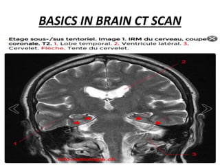 BASICS IN BRAIN CT SCAN
 