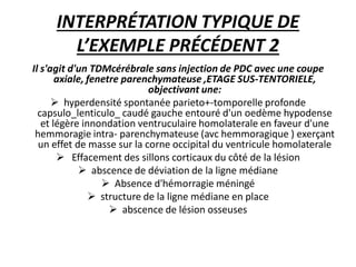 INTERPRÉTATION TYPIQUE DE
L’EXEMPLE PRÉCÉDENT 2
Il s'agit d'un TDMcérébrale sans injection de PDC avec une coupe
axiale, fenetre parenchymateuse ,ETAGE SUS-TENTORIELE,
objectivant une:
 hyperdensité spontanée parieto+-tomporelle profonde
capsulo_lenticulo_ caudé gauche entouré d'un oedème hypodense
et légère innondation ventruculaire homolaterale en faveur d'une
hemmoragie intra- parenchymateuse (avc hemmoragique ) exerçant
un effet de masse sur la corne occipital du ventricule homolaterale
 Effacement des sillons corticaux du côté de la lésion
 abscence de déviation de la ligne médiane
 Absence d'hémorragie méningé
 structure de la ligne médiane en place
 abscence de lésion osseuses
 