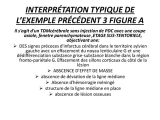 INTERPRÉTATION TYPIQUE DE
L’EXEMPLE PRÉCÉDENT 3 FIGURE A
Il s'agit d'un TDMcérébrale sans injection de PDC avec une coupe
axiale, fenetre parenchymateuse ,ETAGE SUS-TENTORIELE,
objectivant une:
 DES signes précoces d'infarctus cérébral dans le territoire sylvien
gauche avec un effacement du noyau lenticulaire G et une
dédifférenciation substance grise-substance blanche dans la région
fronto-pariétale G. Effacement des sillons corticaux du côté de la
lésion
 ABSCENCE D’EFFET DE MASSE
 abscence de déviation de la ligne médiane
 Absence d'hémorragie méningé
 structure de la ligne médiane en place
 abscence de lésion osseuses
 