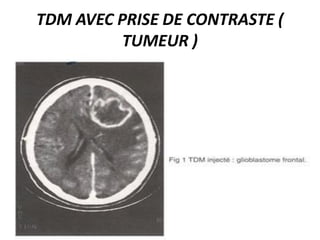 TDM AVEC PRISE DE CONTRASTE (
TUMEUR )
 
