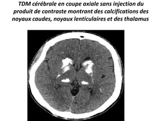 TDM cérébrale en coupe axiale sans injection du
produit de contraste montrant des calcifications des
noyaux caudes, noyaux lenticulaires et des thalamus
 