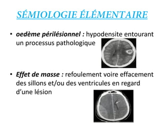 • oedème périlésionnel : hypodensite entourant
un processus pathologique
• Effet de masse : refoulement voire effacement
des sillons et/ou des ventricules en regard
d’une lésion
 