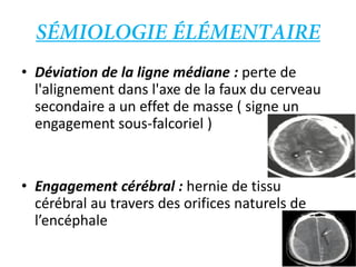 • Déviation de la ligne médiane : perte de
l'alignement dans l'axe de la faux du cerveau
secondaire a un effet de masse ( signe un
engagement sous-falcoriel )
• Engagement cérébral : hernie de tissu
cérébral au travers des orifices naturels de
l’encéphale
 