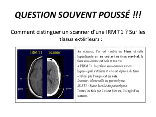 QUESTION SOUVENT POUSSÉ !!!
﻿Comment distinguer un scanner d’une IRM T1 ? Sur les
tissus extérieurs :
 