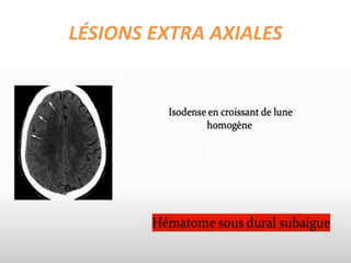 LÉSIONS EXTRA AXIALES
 